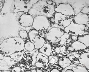 M,50y. | Pneumocystis carinii - lung M,50y. | Pneumocystis carinii - lung
